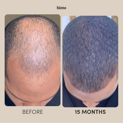 Disaar Anti-Hair Loss — Menos Queda, Mais Força