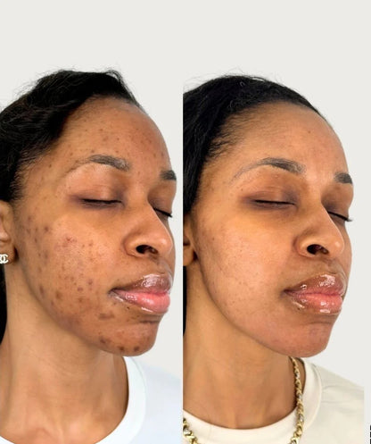 Creme Kojic acid e amino- para clareamento de manchas.