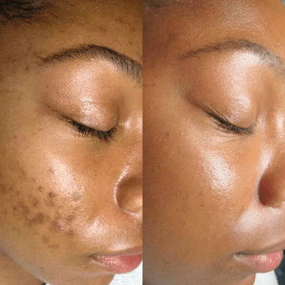 Creme Kojic acid e amino- para clareamento de manchas.