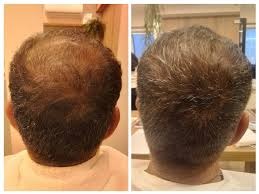 Disaar Anti-Hair Loss — Menos Queda, Mais Força