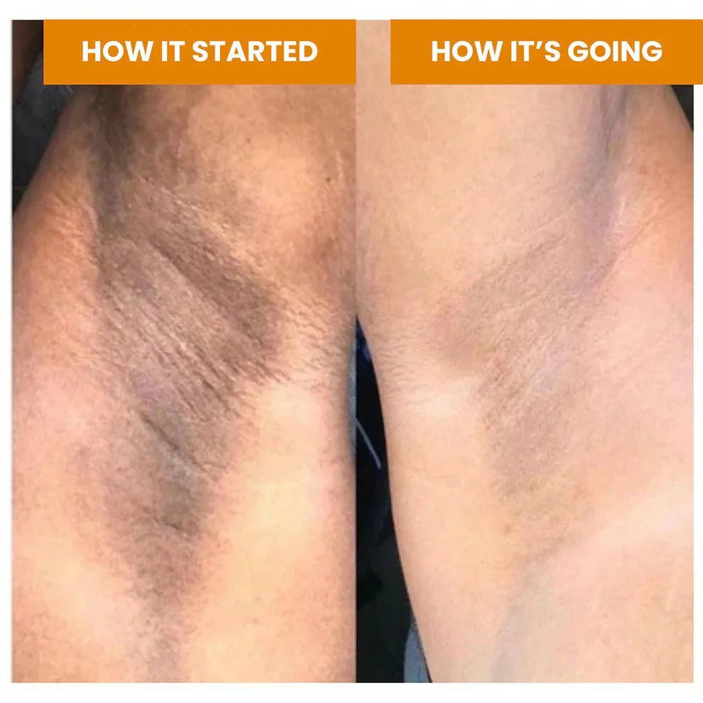 Creme Kojic acid e amino- para clareamento de manchas.